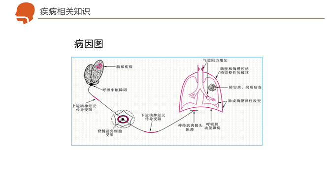 呼吸衰竭护理治疗病例PPT模板_第10页PPT效果图